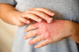 「ステロイドは怖い」は本当？ ここまで変わったアトピー性皮膚炎治療と、正しい外用薬の使い方 画像