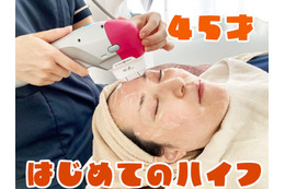 【美容】45歳、はじめてのハイフ。たるんだ顔はどれだけ変わるのか！？