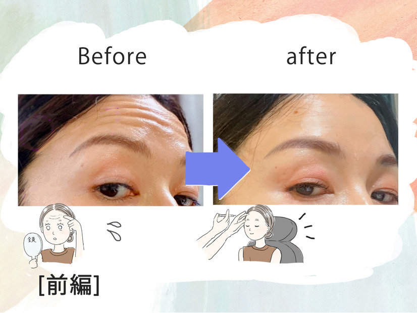「おでこにシワがなくなるだけでこんなに違うの!?」43歳、5分で若見えするコスパ抜群な美容医療にハマった理由