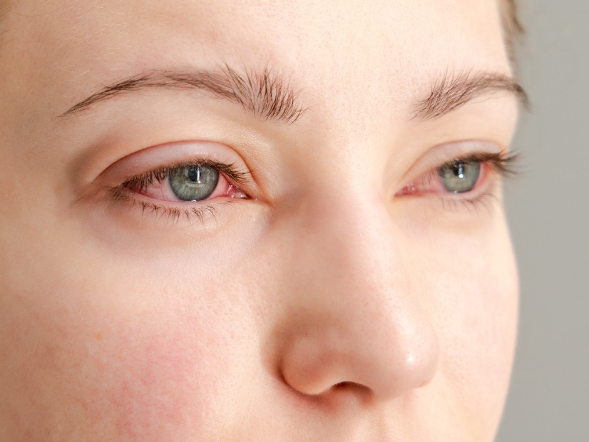 「目のかゆみ」がつらすぎる…その花粉症、実は“肝の疲れ”かも？漢方の専門家がおすすめする「酸味」と「苦味」の食べ物