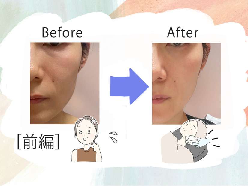 美容課金にハマった44歳が人生初のハイフを体験。「実は一番悩んでいた」たるみはどう変わるのか？気になる痛みは？