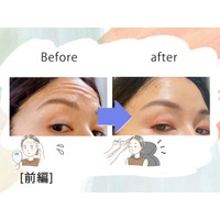 「おでこにシワがなくなるだけでこんなに違うの!?」43歳、5分で若見えするコスパ抜群な美容医療にハマった理由