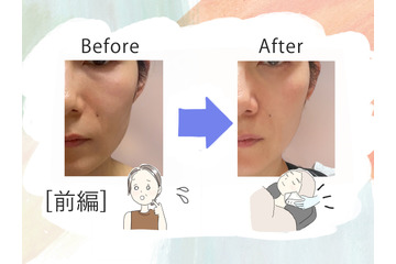 美容課金にハマった44歳が人生初のハイフを体験。「実は一番悩んでいた」たるみはどう変わるのか？気になる痛みは？ 画像