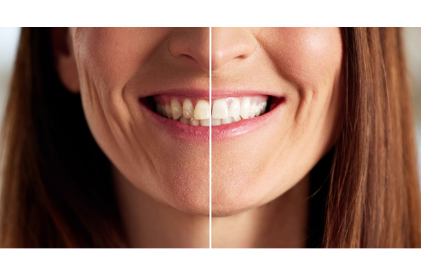 「歯ぐきの老化でオバサン化が加速」。「エストロゲンが減少」する更年期女性ほど歯ぐきケアが大事な理由とは【専門家が解説】
