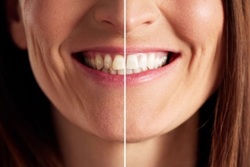 「歯ぐきの老化でオバサン化が加速」。「エストロゲンが減少」する更年期女性ほど歯ぐきケアが大事な理由とは【専門家が解説】 画像