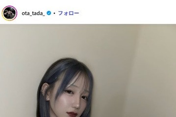 「月曜から夜ふかし」多田さん「腫れがしぶといよ」両顎・輪郭手術から1ヶ月の経過報告「かなり良くなってきてますね」 画像
