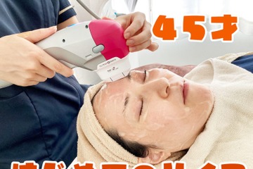 【美容】45歳、はじめてのハイフ。たるんだ顔はどれだけ変わるのか！？ 画像