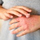 「ステロイドは怖い」は本当？ ここまで変わったアトピー性皮膚炎治療と、正しい外用薬の使い方 画像